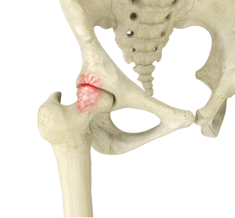 Femoro Acetabular Impingement (FAI)