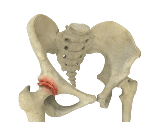 Osteoarthritis of the hip